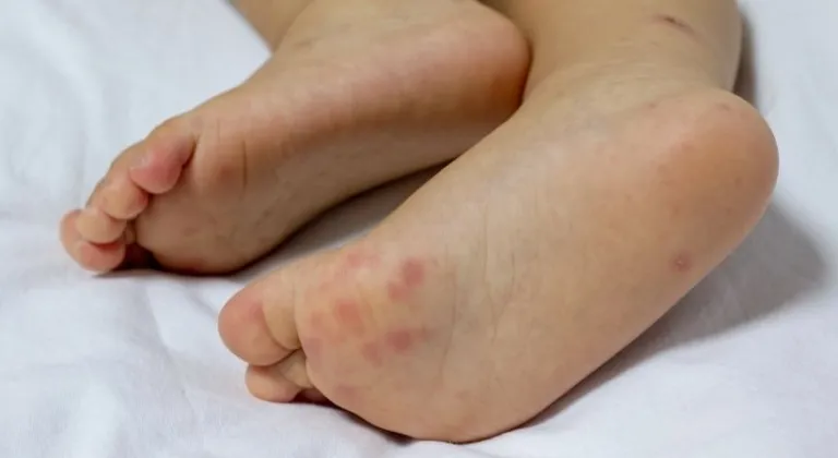 El ayak hastalığı nedir? Belirtileri, tedavileri ve nedenleri