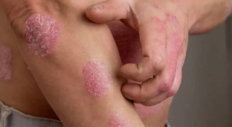 Sedef hastalığı nedir? Belirtileri ve tedavileri