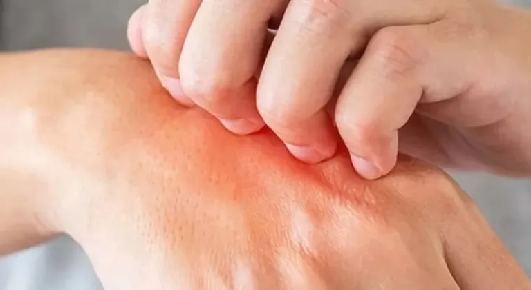 Soğuk yanığına ne iyi gelir ve nasıl düzelir?