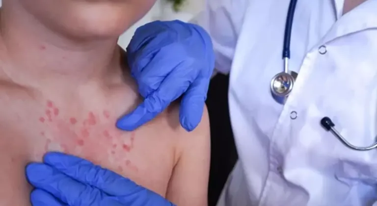 Vakalar son 30 yılda pik yaptı! İki haftada ortaya çıkıyor, 3 yıl kadar sürüyor