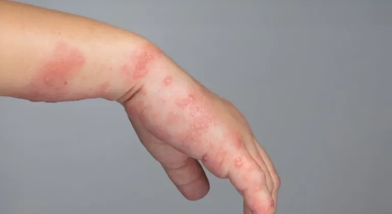 Zona hastalığı nedir? Belirtileri, tedavileri ve nedenleri